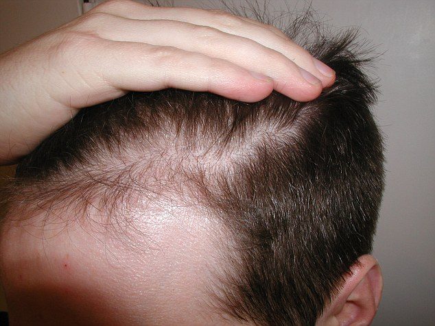 058D1F9E0000044D 3044276 Male or female pattern hair loss is the most common type Half of a 7 1429313998990