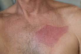 treat chemical burn from hair removal cream